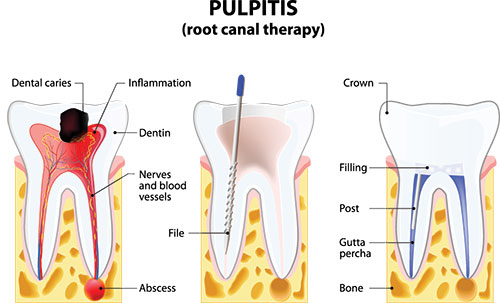 Bayonne Root Canals