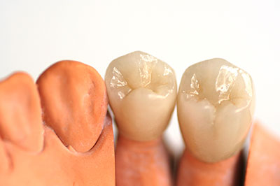 Dental Crowns Bayonne