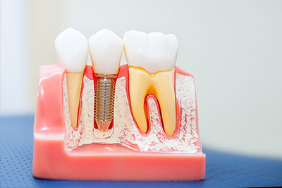 Dental Implants Bayonne