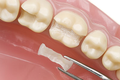 Bayonne Dental Inlays and Onlays